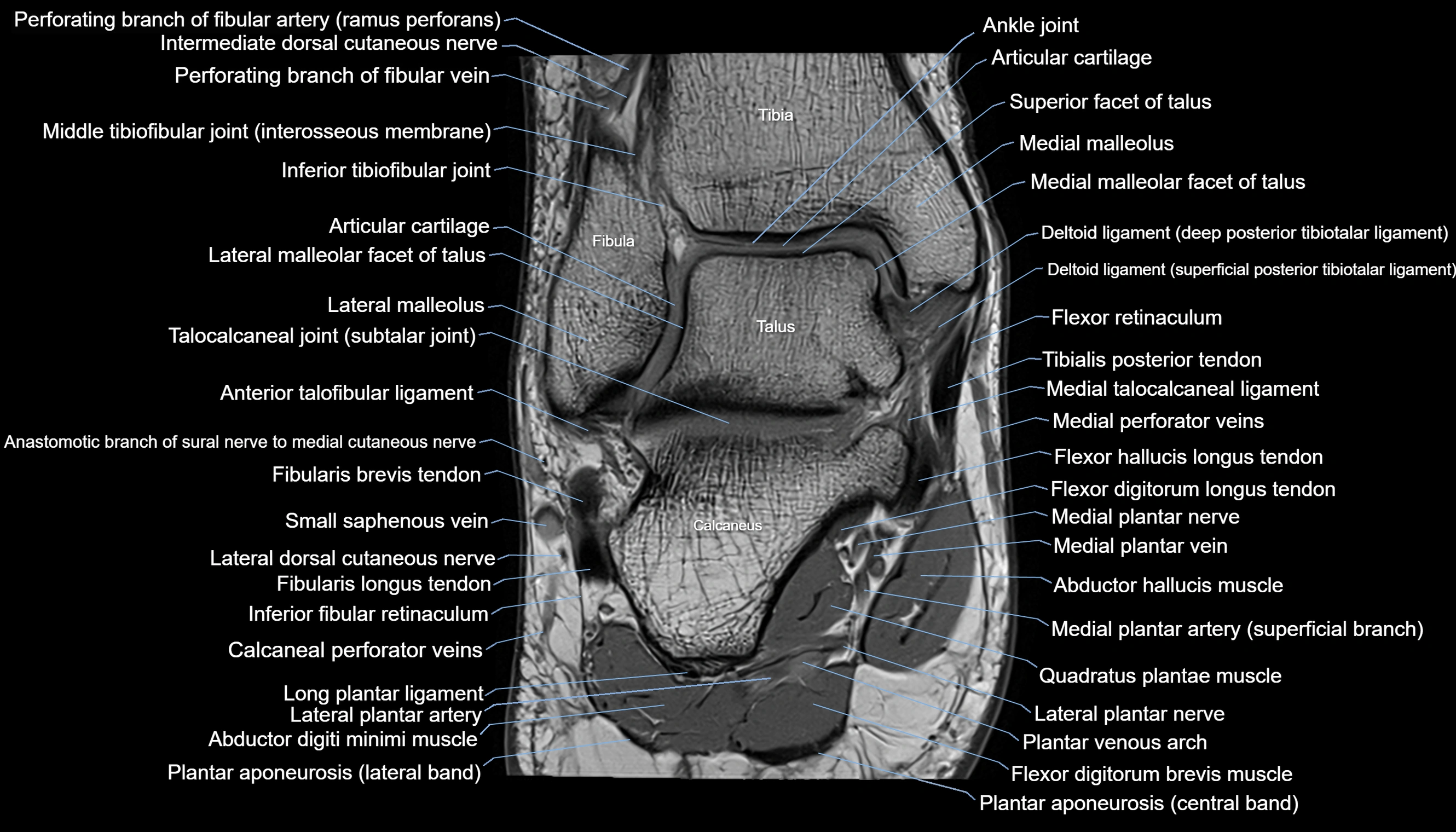 Ankle coronal anatomy 3T MRI images -img-11001-00013.webp